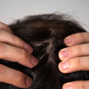 Image of male scratching his flakey scalp