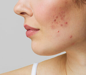 acne