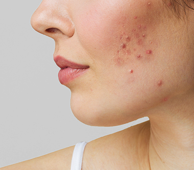 acne