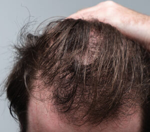 hair loss